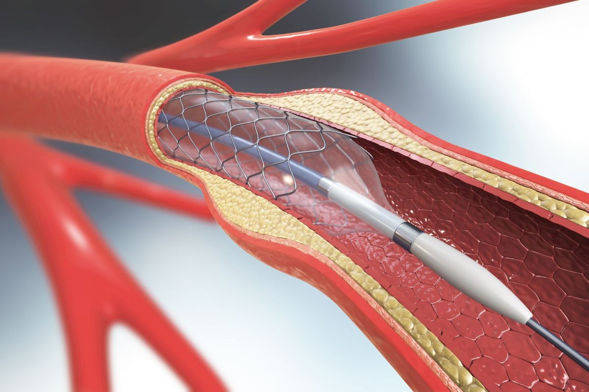 Cardiac stent