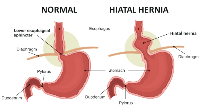 Hiatal Hernia