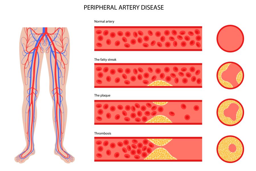 Peripheral artery disease chart