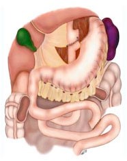 Gastric Bypass Illustration