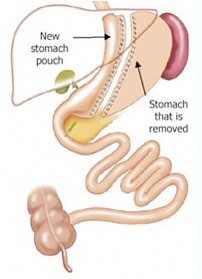 Gastric Sleeve Illustration