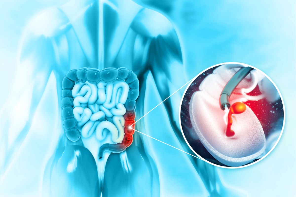 Colonoscopy polyps