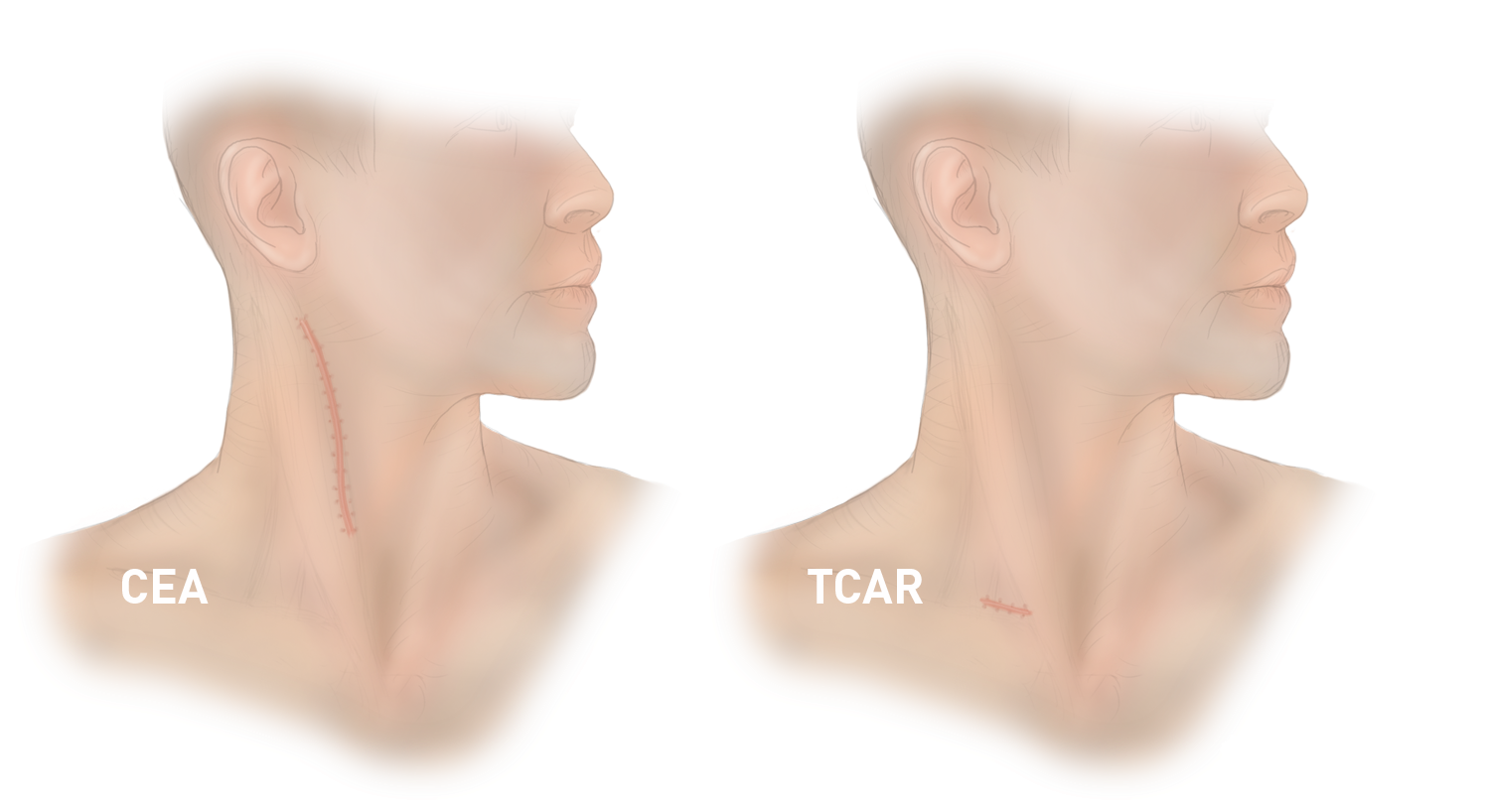 TCAR vs CEA Scars